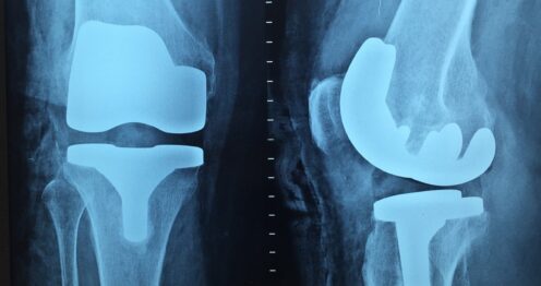 tiempo-recuperacion-reemplazo-de-rodilla